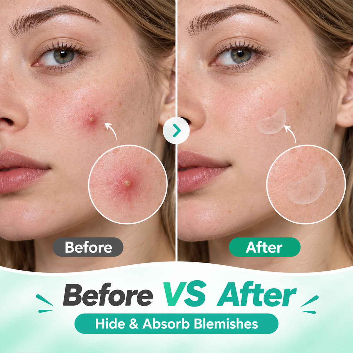 GTT Invisible Acne Patches — Hydrocolloid, Wear Under Makeup